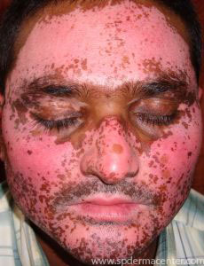 Vitiligo-OnTreatment